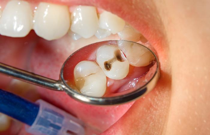 Cavity