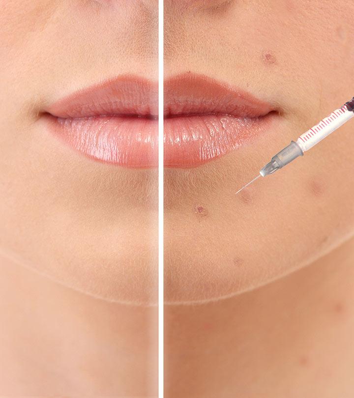 Injeções de cortisona para acne o que você precisa saber sobre elas