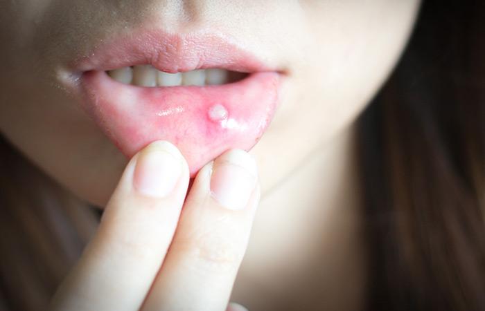 Mouth blisters