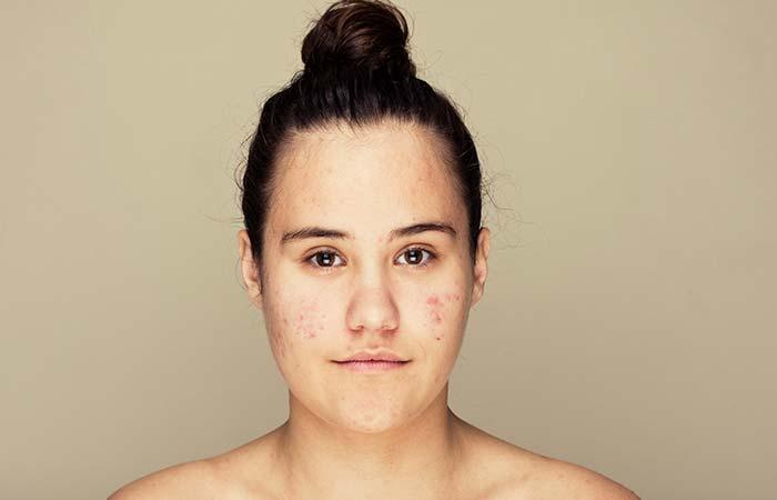 Treatment of acne