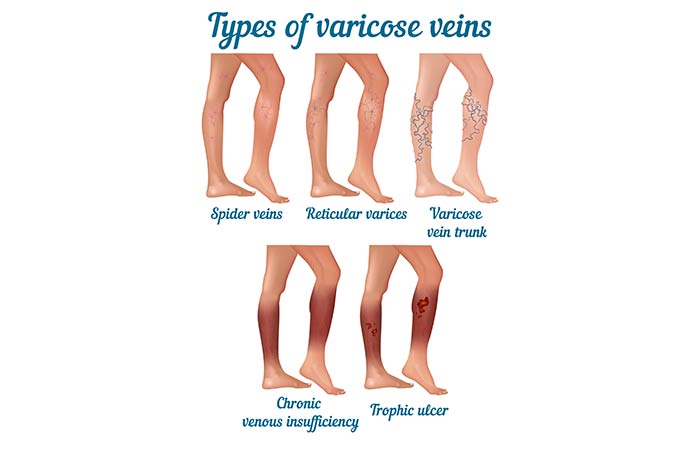 Types of Varicose Veins in Hindi (2)