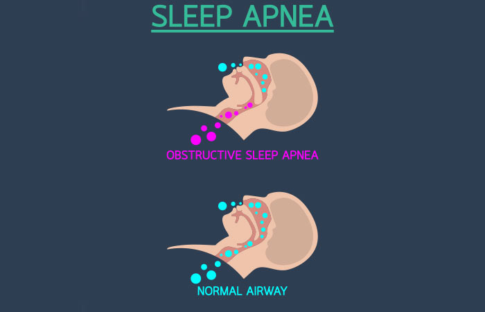 What is Sleep Apnea in Hindi