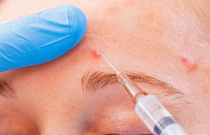 Cortisone shots for acne