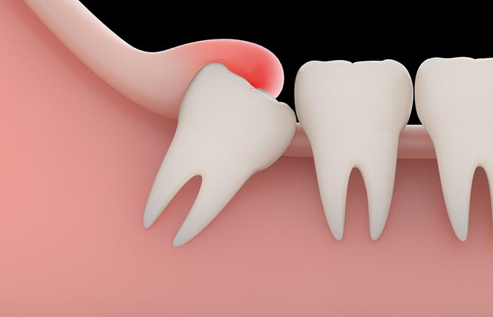 Causes of Wisdom Tooth Pain in Hindi