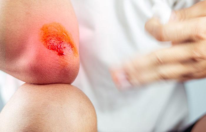 Cuts & Wounds (Antibacterial, Antiseptic)