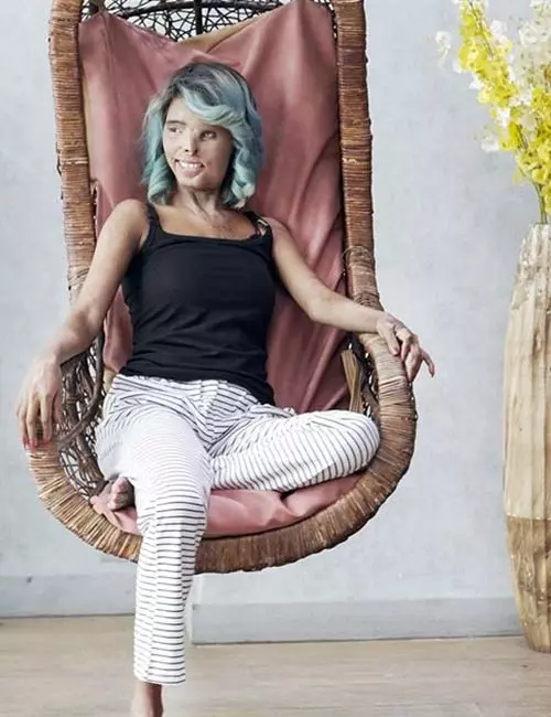  Here’s How This Acid Attack Survivor