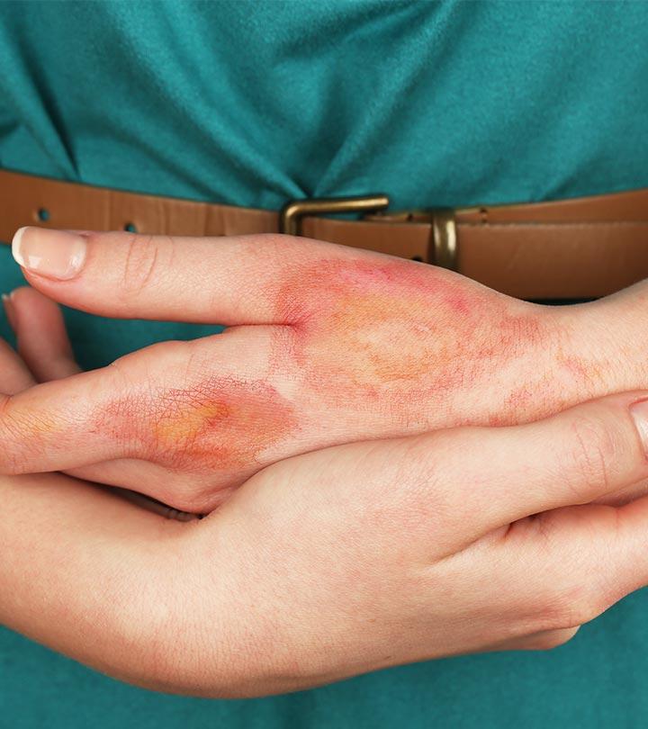 Home Remedies For Burns in Hindi