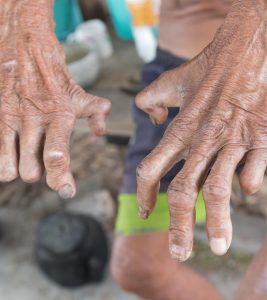 Leprosy Causes, Symptoms and Treatment in Hindi