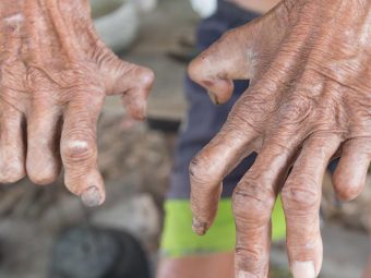 Leprosy Causes, Symptoms and Treatment in Hindi