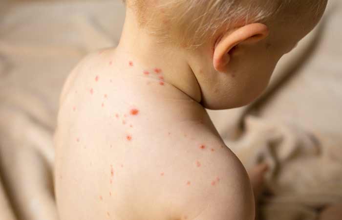 Measles Symptoms in Hindi