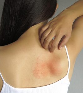 Skin Allergy Symptoms and Home Remedies in Hindi