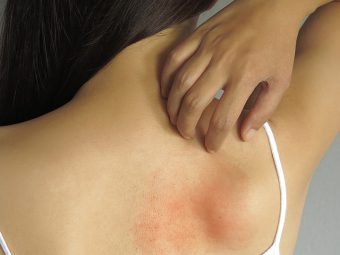 Skin Allergy Symptoms and Home Remedies in Hindi