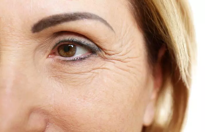 What Are The Different Types Of Wrinkles