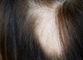 एलोपेशीया के कारण, लक्षण और घरेलू उपाय - Alopecia Causes ...