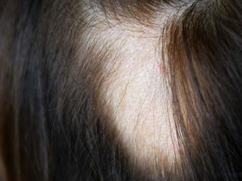 Alopecia Causes, Symptoms and Home Remedies in Hindi