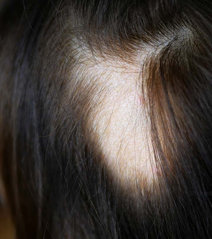 एलोपेशीया के कारण, लक्षण और घरेलू उपाय – Alopecia Causes, Symptoms and Home Remedies in Hindi