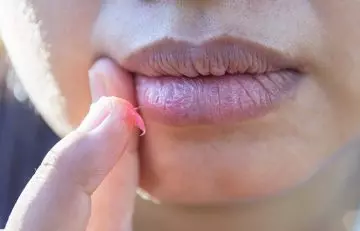 Cracked Or Dry Lips