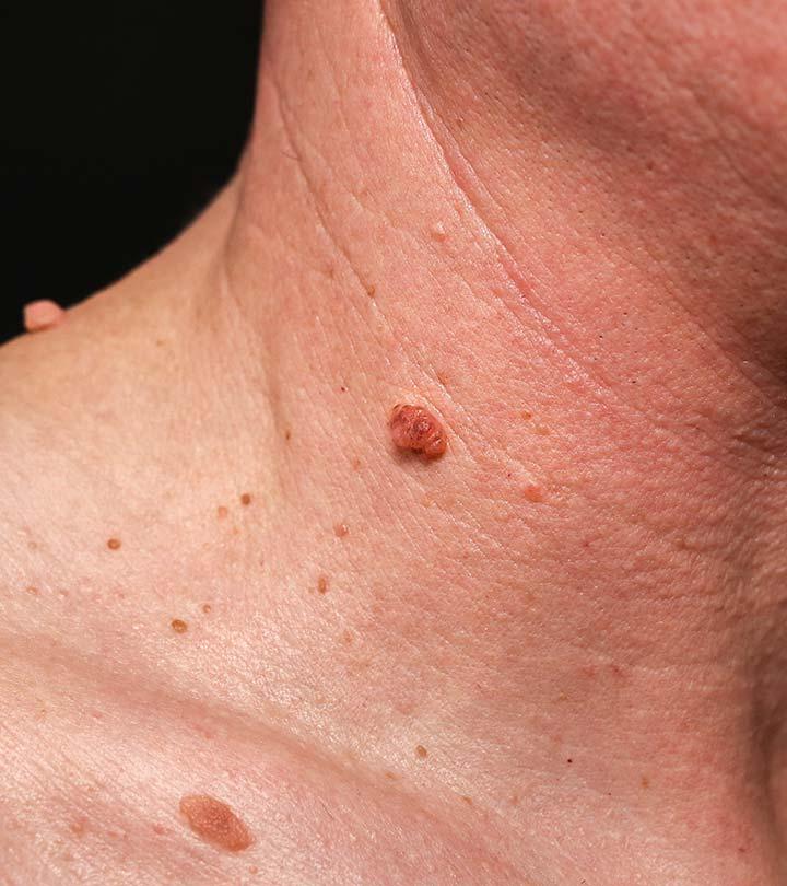 Warts Symptoms and Treatment in Hindi