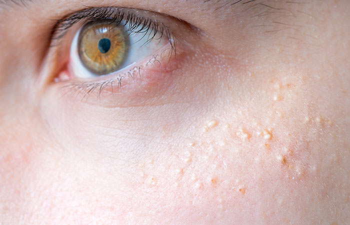 Acne Breakouts Could Get Way Worse