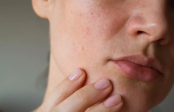 Acne Breakouts From Skin To Phone Contact