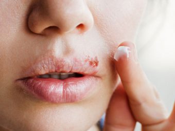 Herpes Causes, Symptoms and Home Remedies in Hindi