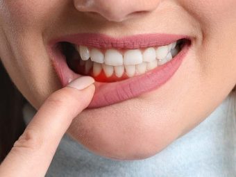 Periodontitis (Gum Disease) Causes, Symptoms and Home Remedies in Hindi