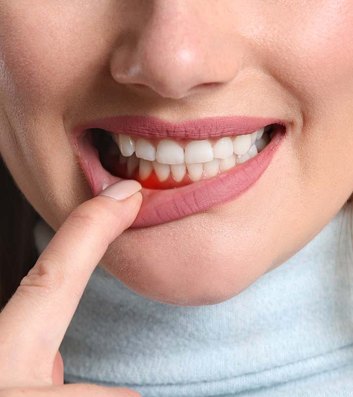 पायरिया के कारण, लक्षण और घरेलू उपाय - Periodontitis (Gum Disease ...
