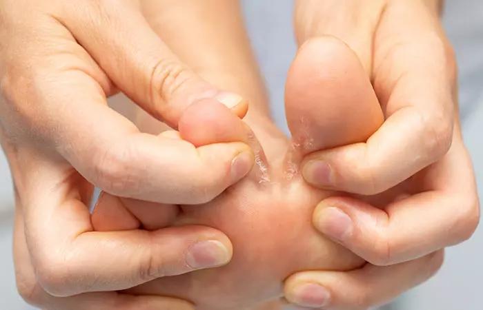 Athlete's Foot