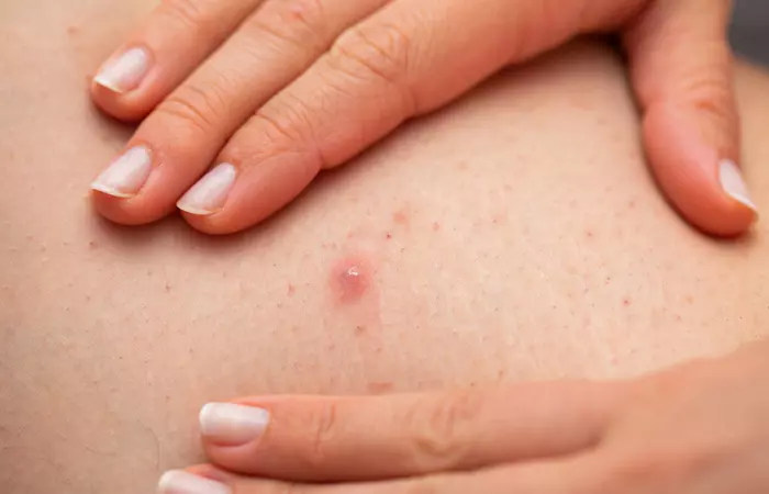 Folliculitis