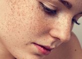 झाई (फ्रेकल्स) के कारण और घरेलू उपाय - Freckles Causes and Home ...
