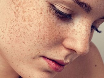 Freckles Causes and Home