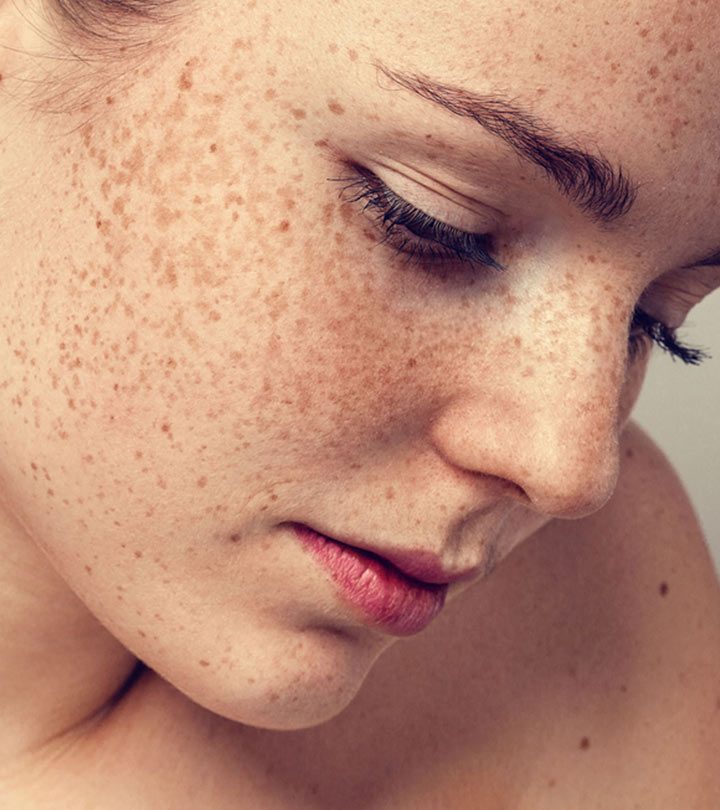 झाई (फ्रेकल्स) के कारण और घरेलू उपाय – Freckles Causes and Home Remedies in Hindi