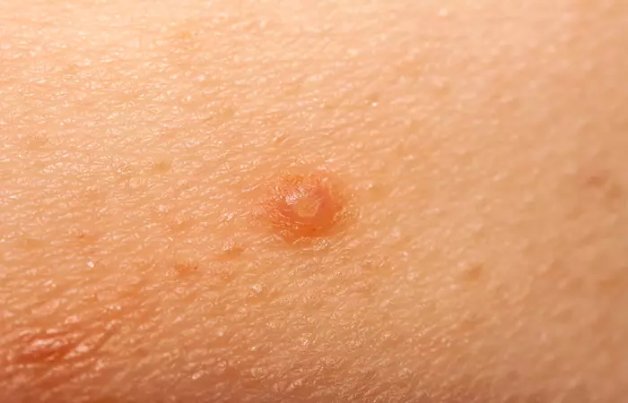 Molluscum contagiosum