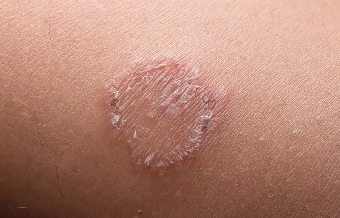 Ringworm