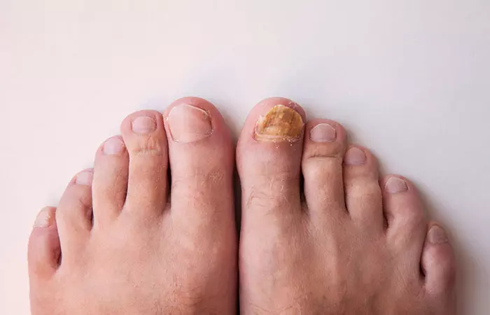 Toe Nail Fungus