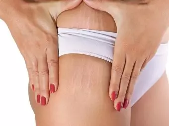 How To Get Rid Of White Stretch Marks?