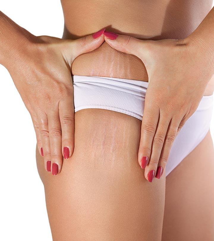 How To Get Rid Of White Stretch Marks