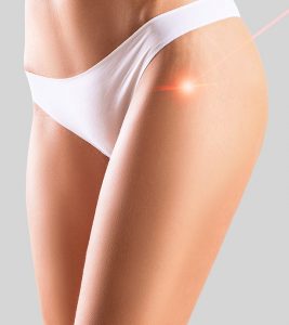 Laser Stretch Mark Removal: Types, Co...