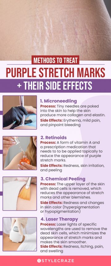 methods to treat purple stretch marks + their side effects (infographic)