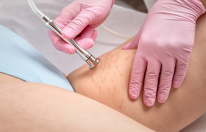 Microdermabrasion may get rid of red stretch marks