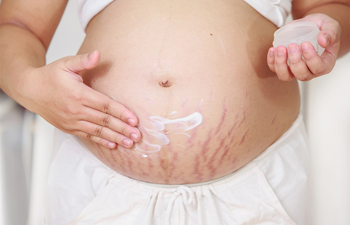 Pregnant woman applying moisturizer on her red stretch marks