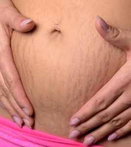 Red Stretch Marks: Causes, Treatments...