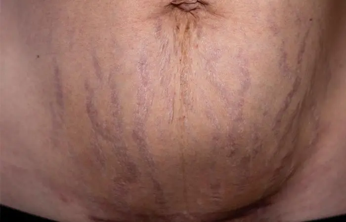 What are purple stretch marks, and how do you get them