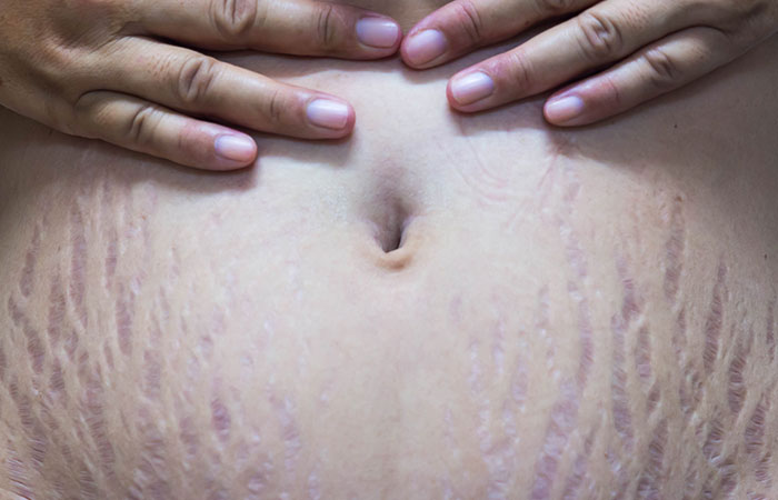 Get rid of red stretch marks on the belly
