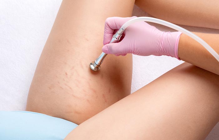 Woman getting microdermabrasion on stretch marks