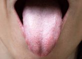 सफेद जीभ के कारण, लक्षण और घरेलू उपाय - White Tongue Causes ...