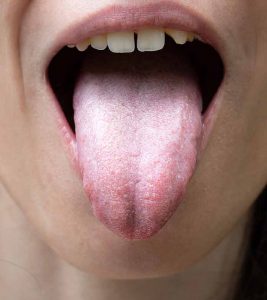 White Tongue Causes, Symptoms and Home Remedies