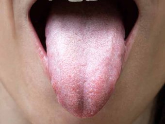 White Tongue Causes, Symptoms and Home Remedies