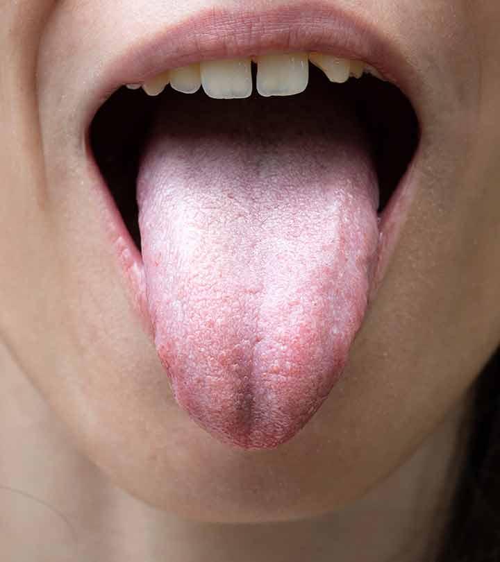  White Tongue Causes Symptoms 