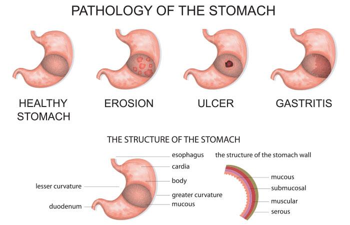 home-remedies-for-gastric-problem